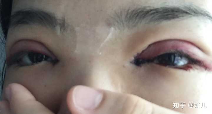 有割双眼皮后悔了的吗?