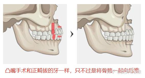如果说 带有一点轻微的骨性,不愿意做凸嘴手术的话,也可以做拔牙正畸