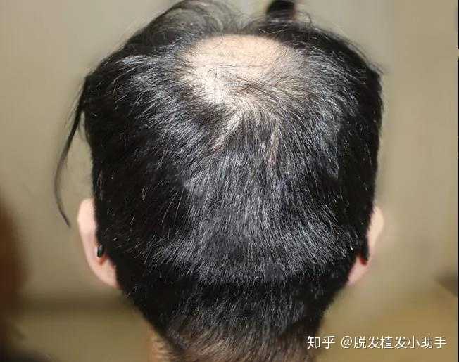 有一种脱发叫"命里有它" 我国脱发人群高达2亿,其中95%以上属遗传