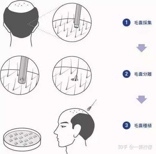 植发费用=种植毛囊数量*毛囊单价