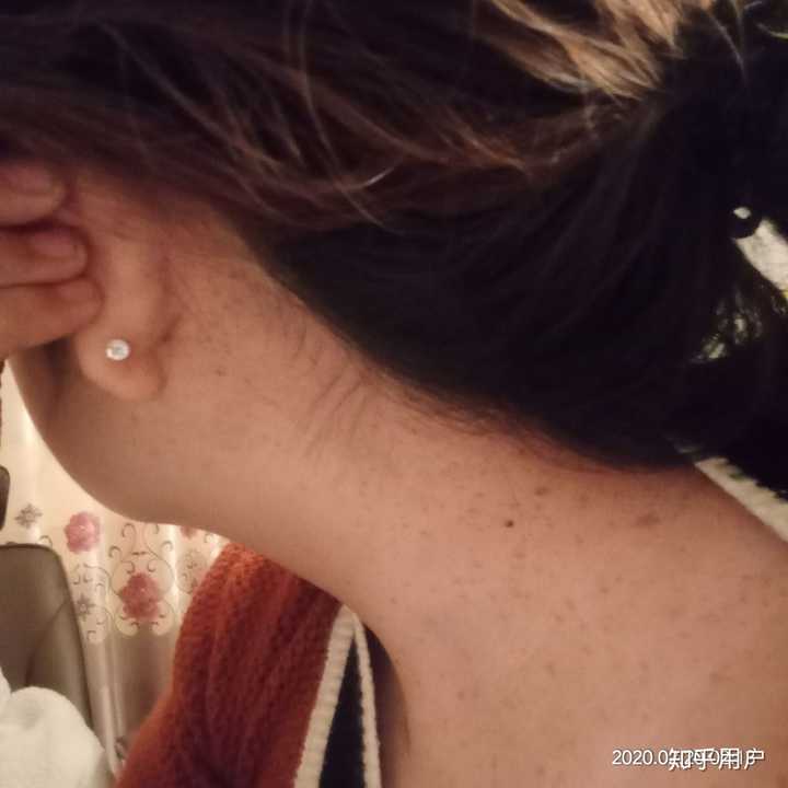 男生会介意女生身上大面积的胎记吗?