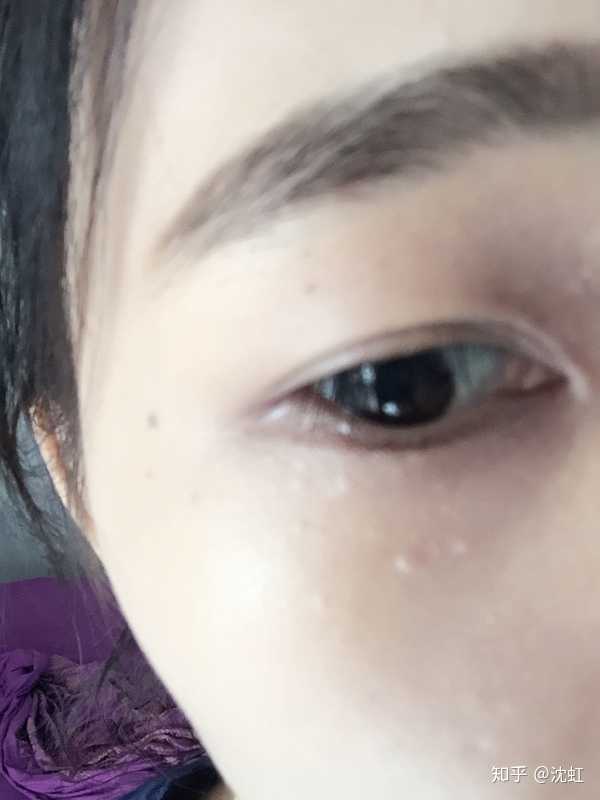 眼睛下的脂肪粒怎么去?