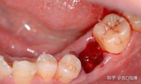 拔牙后疼多久?