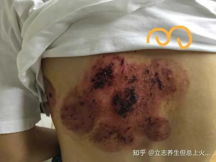 什么是带状疱疹?多久可以痊愈?