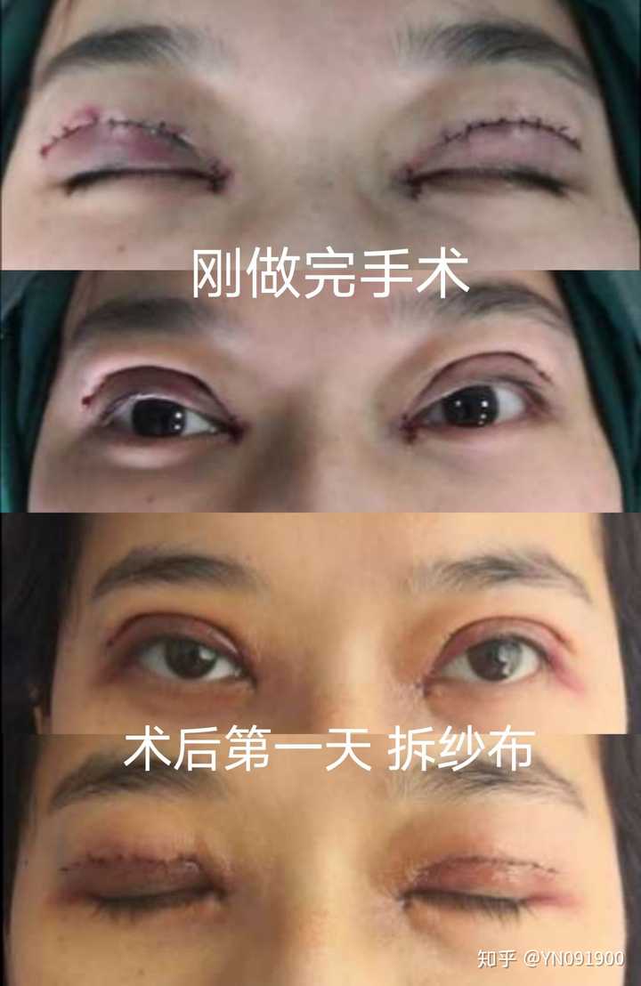 秦皇岛哪个医院割双眼皮好?