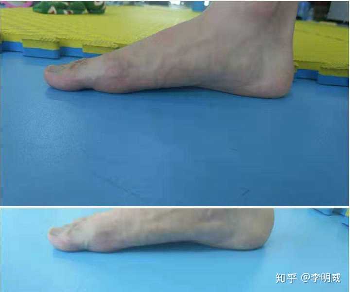 足外翻能矫正吗?