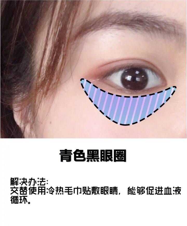 14岁有黑眼圈用什么眼霜比较适合?