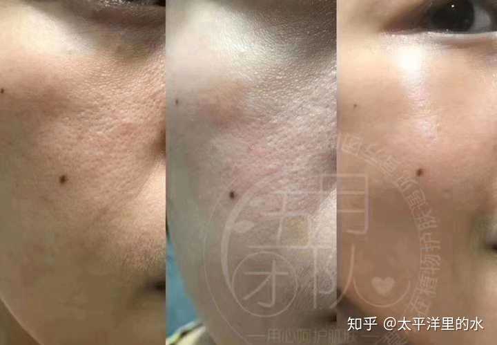 长过痘痘的额头暗沉好像多了一层死皮一样是什么症状该怎么解决?