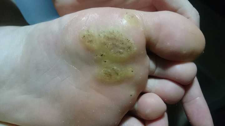 这是什么病情 怎么治 大母脚趾头下面的脚底板按压会疼 走路也疼 有点