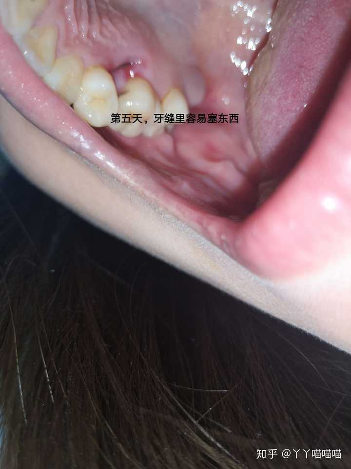 拔牙后恢复过程全解?