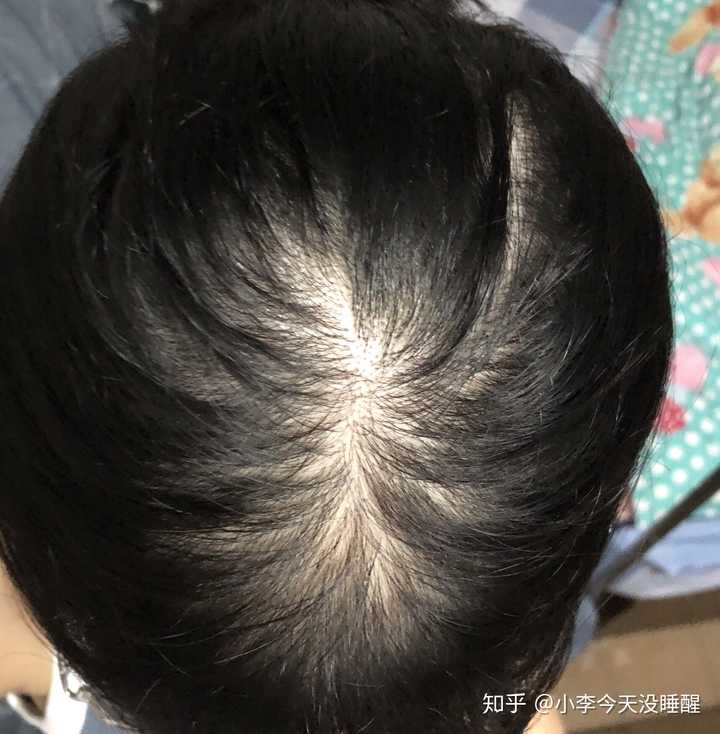 女生头顶头发少是什么体验 ?