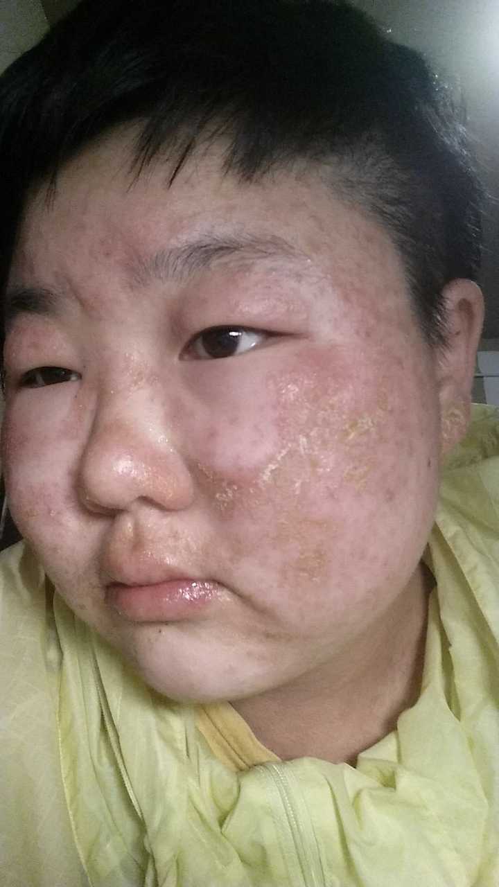 紫外线过敏/日光性皮炎 是一种怎样的感受?