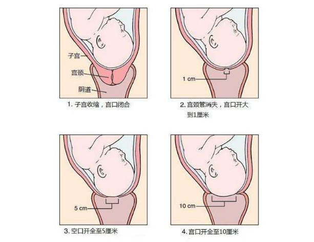 顺产好还是剖腹产好?