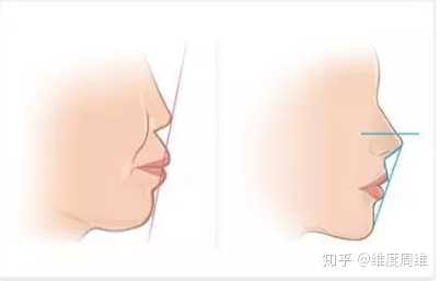 你好,根据题主的描述来说,山根低突嵯缘昧巢勘馄,凸嘴的问题就要看
