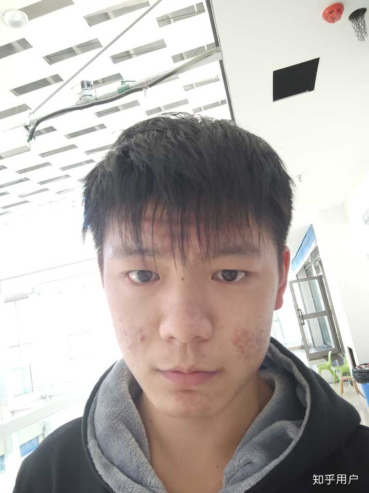是不是脸上有痘痘的男孩子女生都不喜欢?