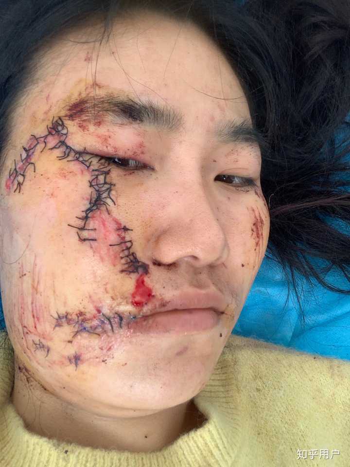 女生脸上有疤是怎样的体验?