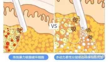 抽脂肪的时候痛感有几成?是否建议做自体脂肪填充?后遗症有没有?