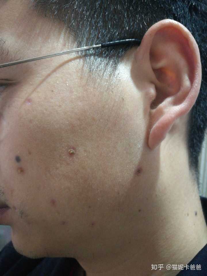 激光点痣祛痣祛斑是什么体验?