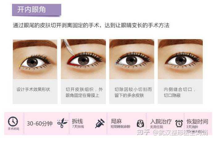 为什么要开内眼角