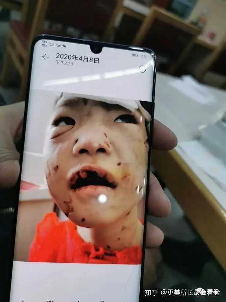 嘴里的牙齿也全都被打到落了下来,除此之外孩子浑身上下都有被烟头烫