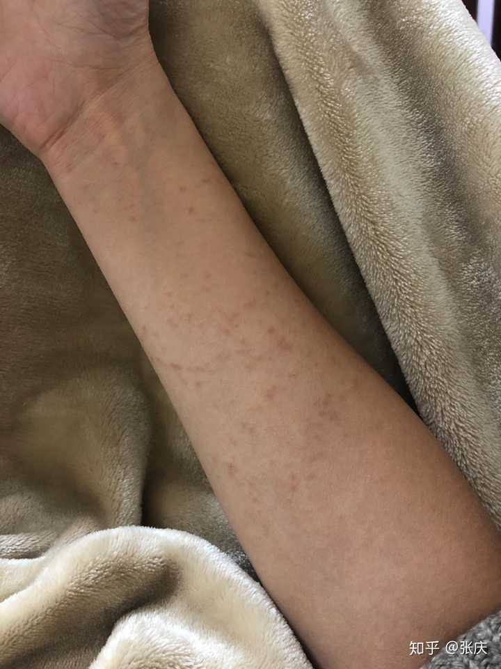 被水母蛰是一种什么体验?