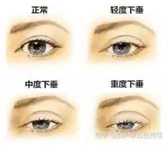 2,导致眼部皮肤松弛,影响美观.