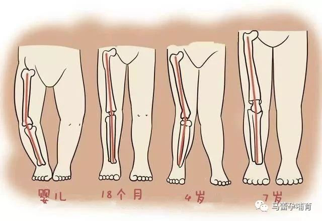 其实,宝宝刚出生的时候基本都会有点o型腿,18个月左右,下肢逐渐变直