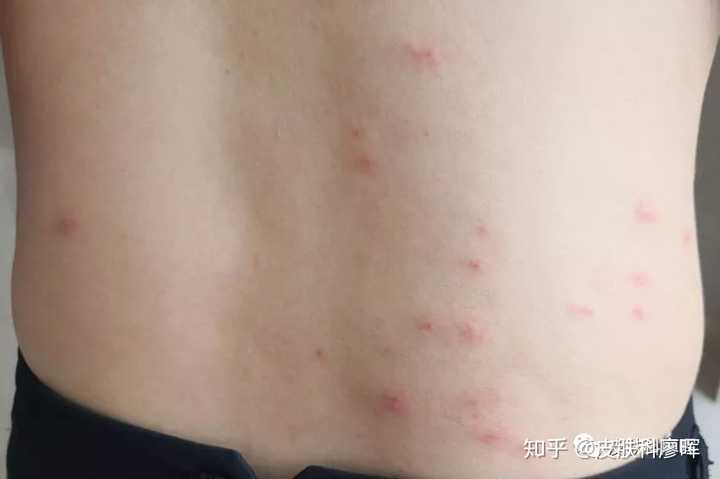虫咬性皮炎怎么治疗?