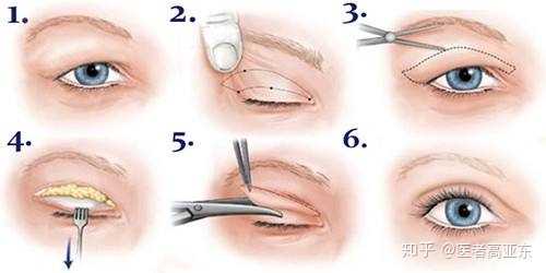 全切双眼皮的优势