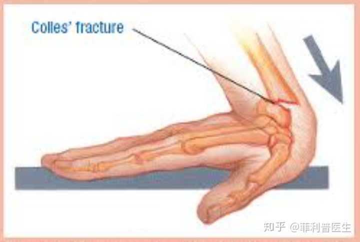 四头肌剧烈收缩引起的髌骨横行骨折,跌倒时手掌撑地造成的colles骨折