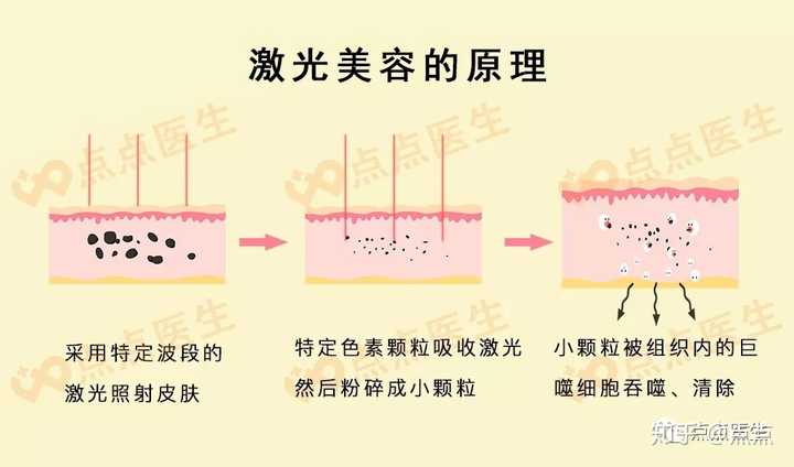 激光美容的原理