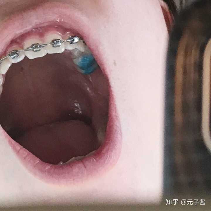因为咬合还是很紧,所以医生给我上排牙的磨牙上粘了牙垫这样咬合起来