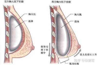 19岁女生aa怎样丰胸?