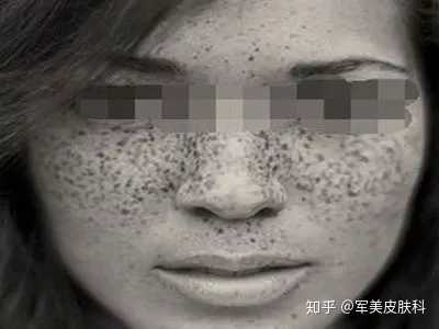 如何判别脸上斑的种类?