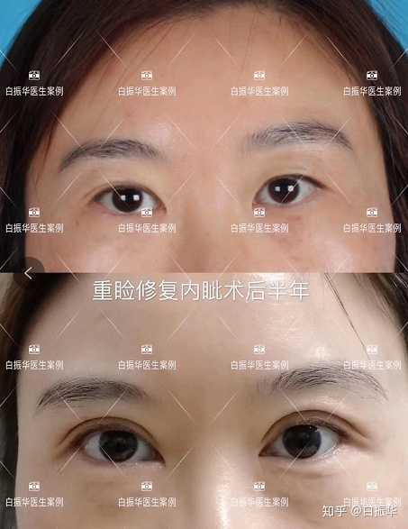 双眼皮修复 开眼角术后四个月