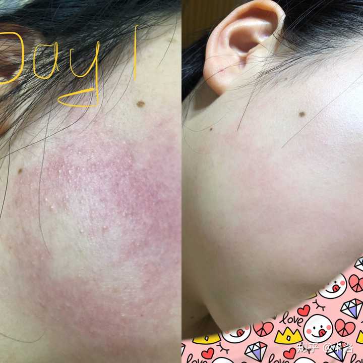 毛囊角质化(鸡皮肤)是否无法改善?