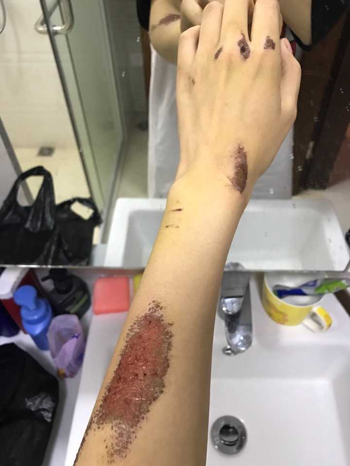 脸部擦伤结痂已经掉了.但是红黑的一片,怎样才能避免留疤?