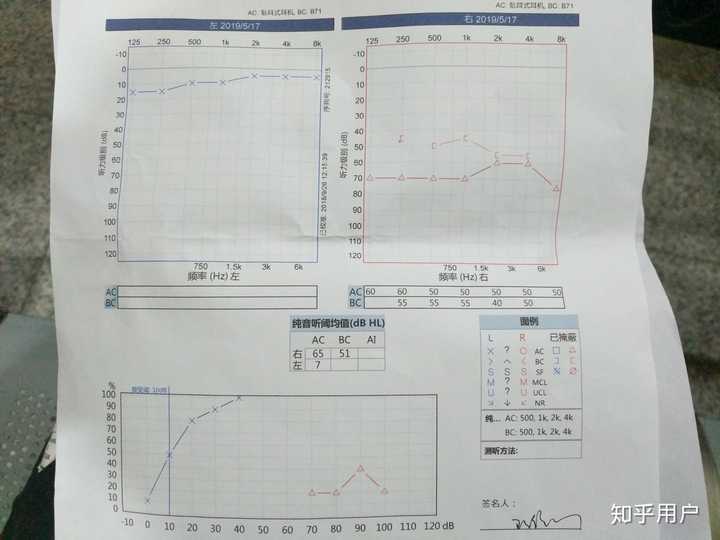 感音神经性耳聋.23岁,右耳听力完全丧失,左耳轻度听损