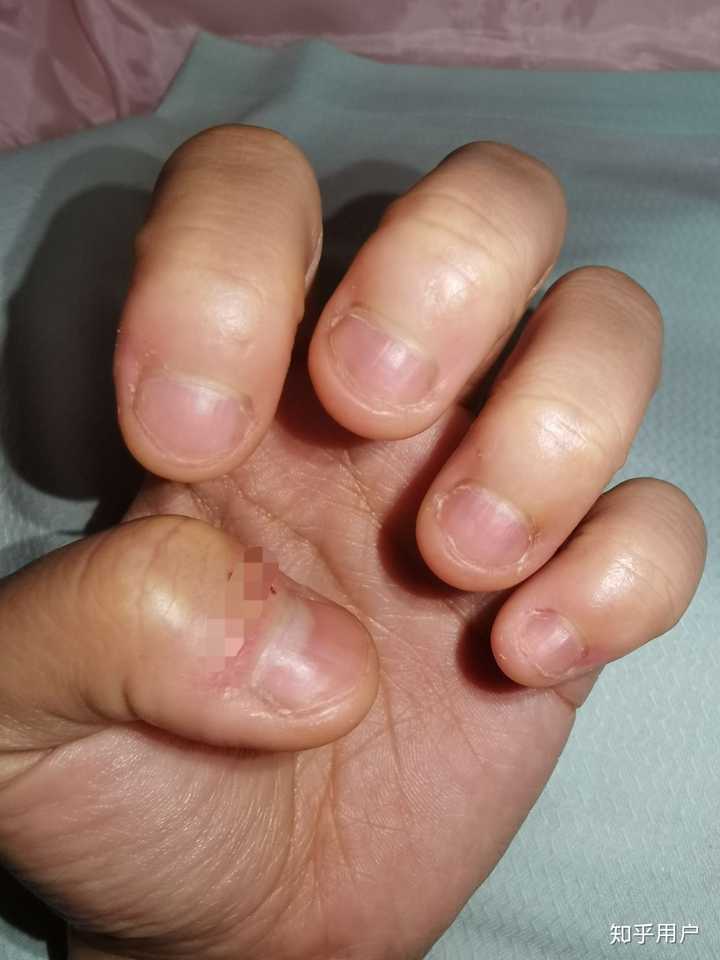 指甲很短而且很丑怎么办?