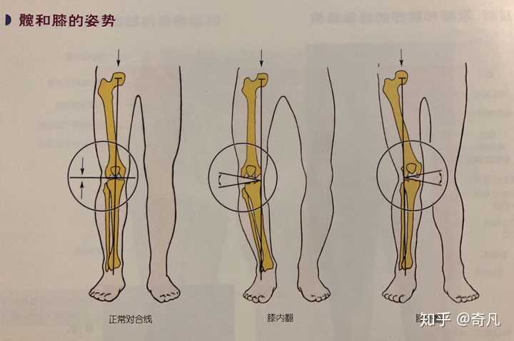 膝内翻的隐患与危害