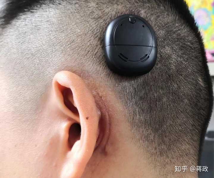 人工耳蜗的费用是不是都很高啊,国内可以做吗?
