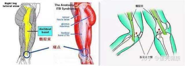 其主要原因是,髂胫束与股骨外上髁过度摩擦,导致韧带或滑囊炎症所致