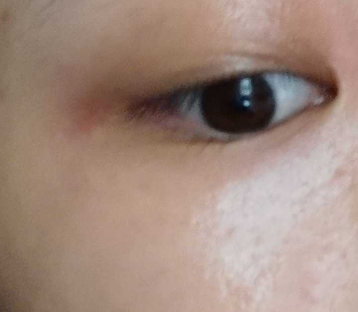 晚上的时候眼睛周围的皮肤突然瘙痒难忍,很红并且开始肿,急求?