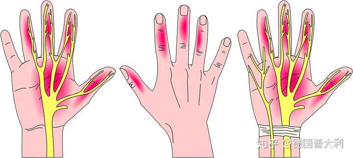 手指头指尖麻木是怎么回事?