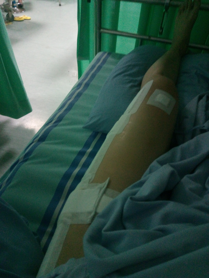 大腿骨折做完手术之后膝盖不能弯曲,2个月之后慢慢弯曲了一些,但是