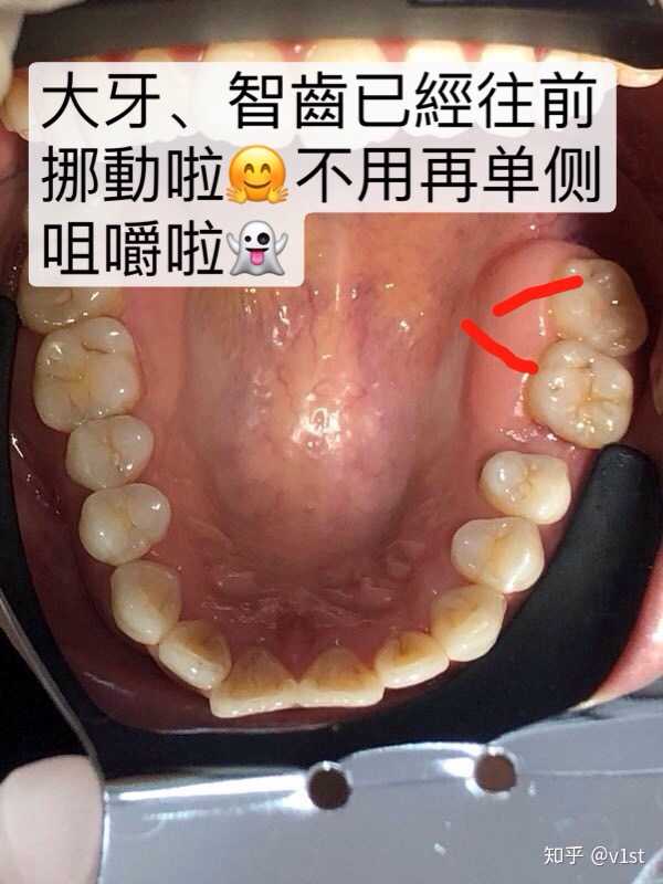 戴过牙套(矫正牙齿)的人脸型变了吗?