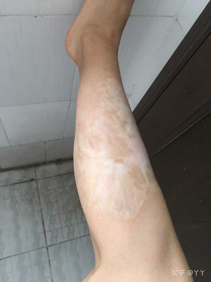 人们看到一个腿上有烫伤疤痕的女孩会怎么想呢?