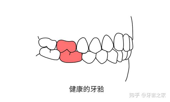 安氏一二三类错牙合都是什么样的?