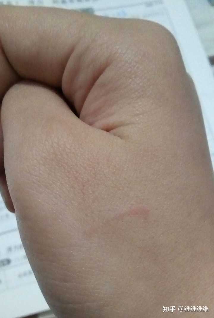 手指被流浪猫牙齿蹭了一下 目测没破皮 没出血 需要引起重视吗?