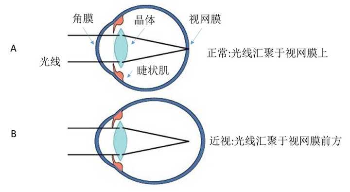 近视的人捐献眼角膜给视力正常的病患,病患会不会也近视了?